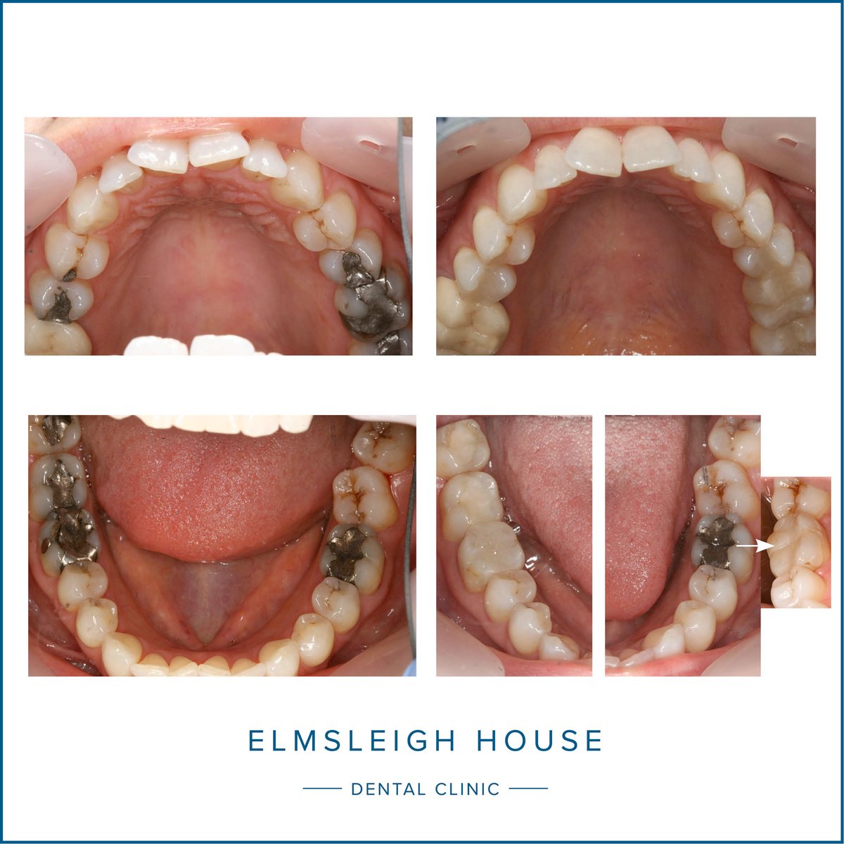 Composite to replace old amalgam fillings
